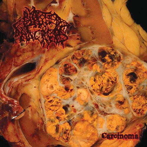 Blasted Pancreas- Carcinoma [ vinyl ]